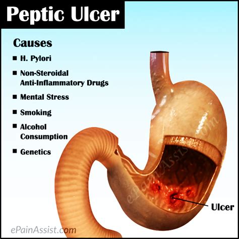 petic ulcer symptoms